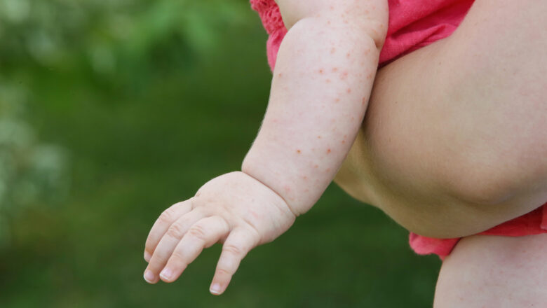 Scarlet Fever in Children: Vaccination and Prevention Methods